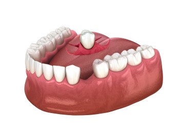 immediate denture