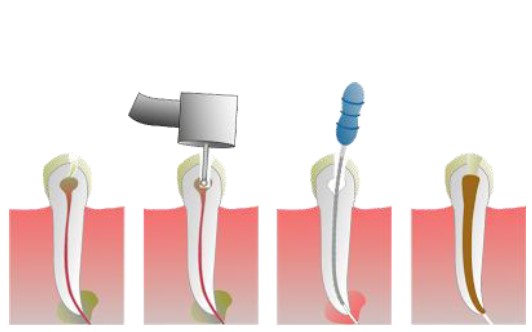 root canal treatment