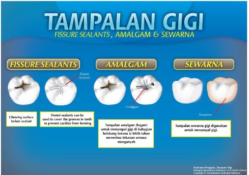 tampalan gigi