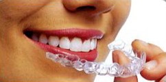 invisalign braces