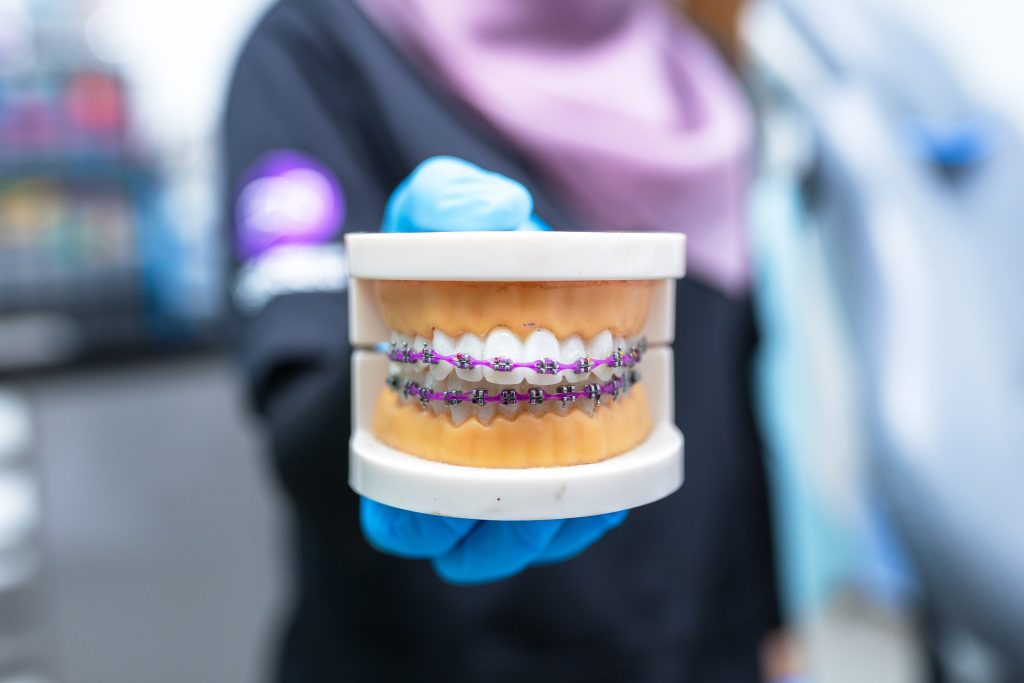 Untuk pesakit yang memerlukan rawatan ortodontik, kami menyediakan perkhidmatan braces gigi di Melaka.