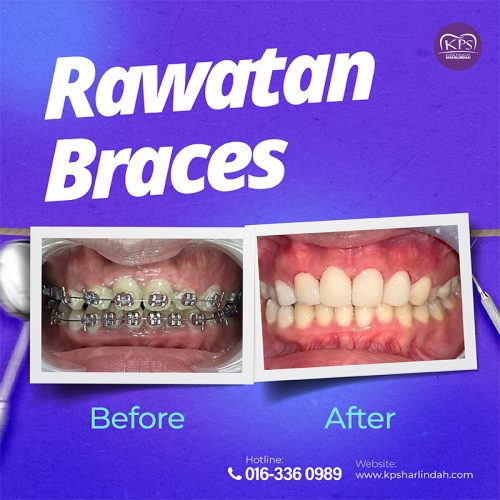 Ortho Before After 2025-04