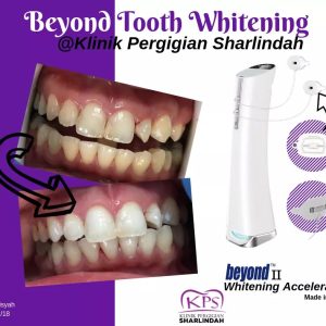 whitening_kps6